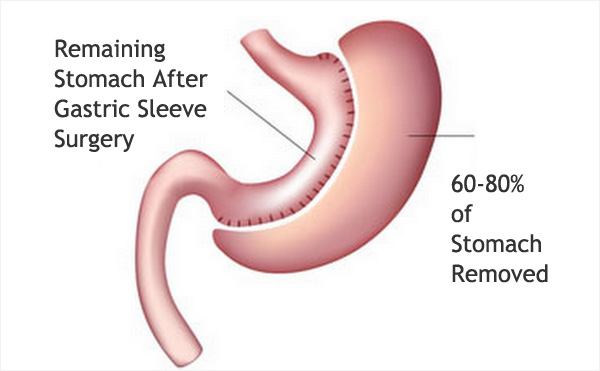 Gastric Bypass And Importance Of Such A Surgery